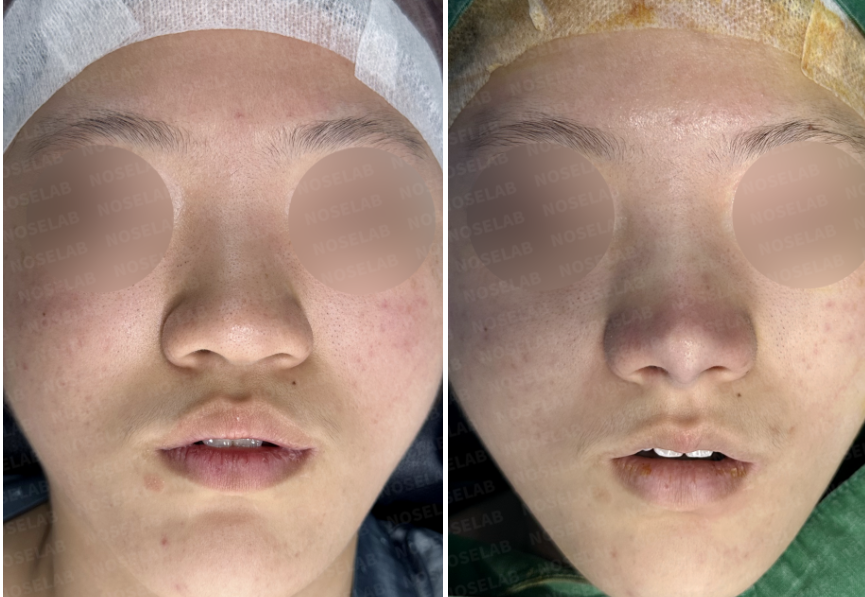 Before and immediately after surgery frontal view showing refinement of bulbous nasal tip, reduced nasal width, and improved tip definition following closed rhinoplasty with rib cartilage septal extension.