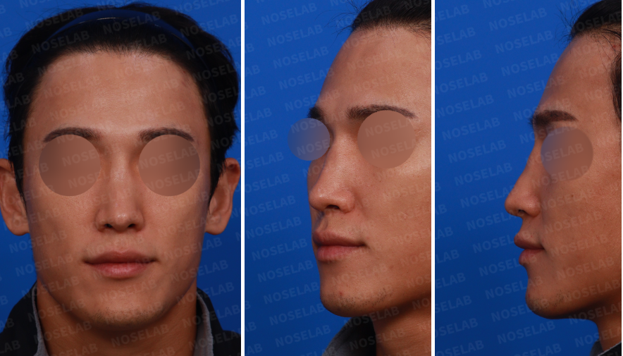 Preoperative design consultation photos of a male patient: frontal view, left oblique side view, and side view for crooked nose correction and nasal bridge analysis.