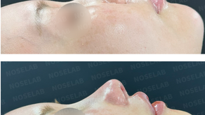 rhinoplasty case at Noselab Clinic in Korea.