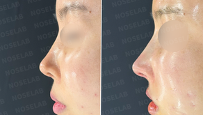 Side-by-side profile images immediately after surgery showing correction of upturned nose and improved columella projection.