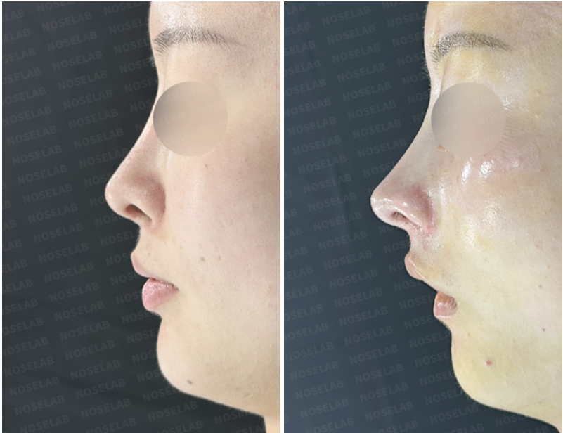 Closed rhinoplasty Korea and upturned tip correction - Before surgery (left) and immediately after surgery (right) profile view photos