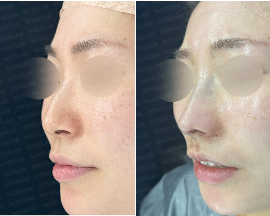 Oblique side view before (left) and immediately after (right) hump nose and deviated nose correction – Nose Lab Clinic