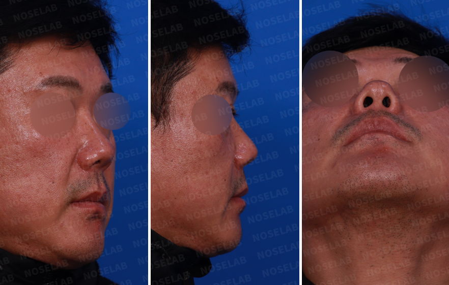 Short and Upturned Nose Correction design consultation – right side, oblique side, and nostril view photos before closed rhinoplasty.
