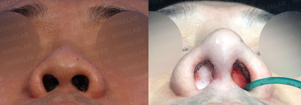 Basal view showing reduced nostril exposure and improved symmetry after Upturned Nose and Asymmetric Nostrils Correction – Closed Rhinoplasty Korea
