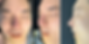 Enhancing nasal height & resolving nasal obstruction – immediate post-surgery frontal, oblique side, and side view photos of patient at Nose Lab Clinic.