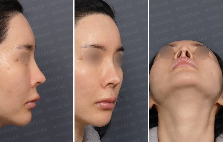 Preoperative consultation images showing right lateral view, right oblique view, and nostril view of a patient with severe nasal obstruction after multiple rhinoplasty surgeries, revealing nostril asymmetry and compromised nasal airway structure.