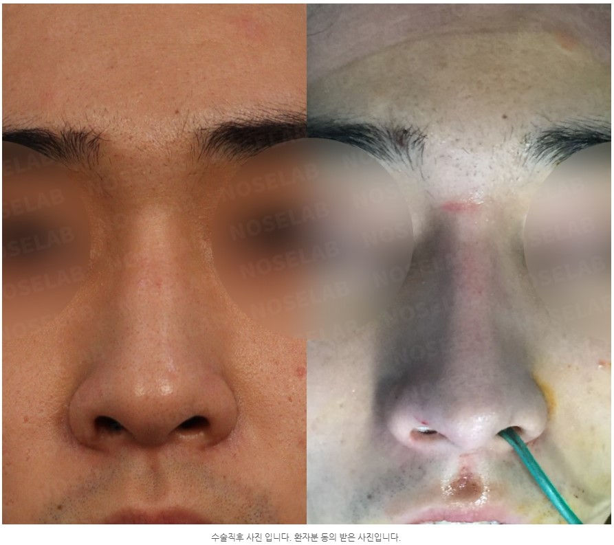 Frontal view before and after Closed Rhinoplasty Seoul – straightened nasal axis and improved symmetry after self rib cartilage reconstruction at NoseLab.
