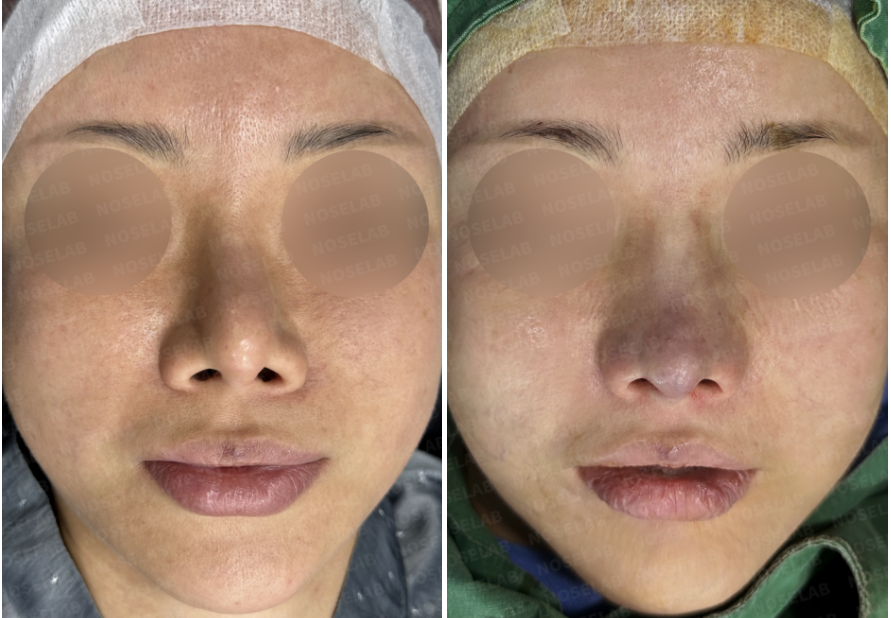 Before and immediately after surgery frontal view showing correction of upturned nasal tip, reduced nostril show, and improved nasal symmetry following revision closed rhinoplasty with rib cartilage reconstruction.