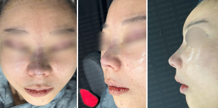 Short Nose Correction – Immediately after surgery frontal, oblique, and side view photos showing elongated nasal line, refined tip projection, and corrected nasolabial angle after closed rhinoplasty.