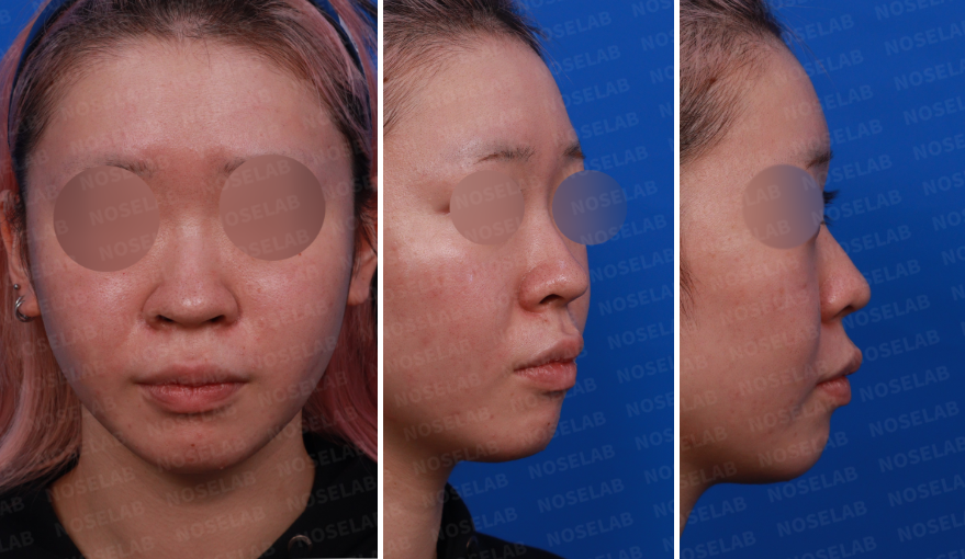 Design consultation photos: frontal, right oblique, and side view before bulbous nose correction surgery