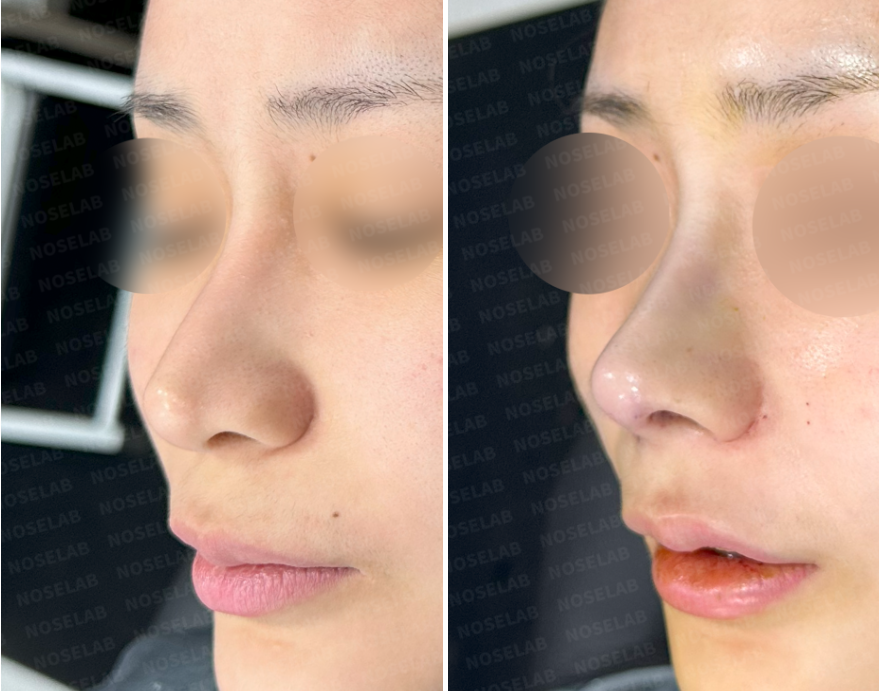 Post-Orthognathic Septal Reconstruction oblique view – before and immediately after closed rhinoplasty revision showing refined nasal tip contour and improved symmetry
