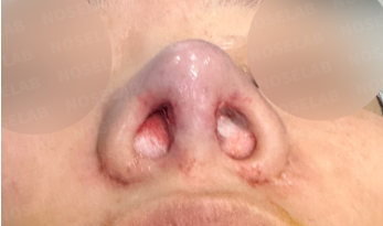Immediately after autologous rib cartilage revision rhinoplasty in Korea – nostril view showing improved symmetry, straightened columella, and correction of pinched nostrils.