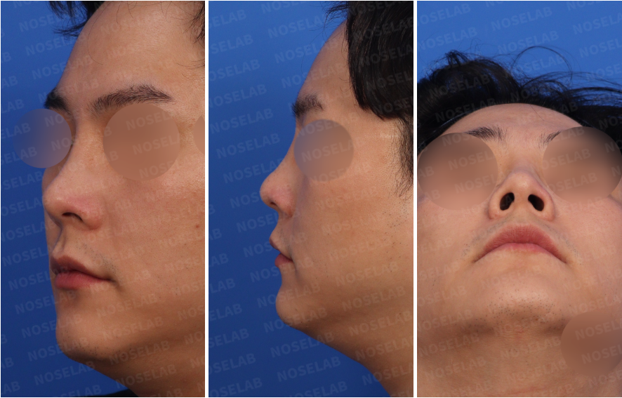 Preoperative consultation photos for male rhinoplasty Korea: right side view, right oblique side view, and nostril view