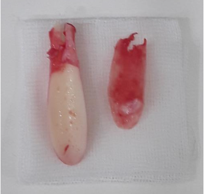 Removed Silitex implant with Gore-Tex and silicone layers from rhinoplasty revision case