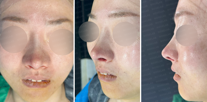 Postoperative frontal, lateral, and oblique view images taken immediately after revision rhinoplasty, showing nasal contour and swelling.