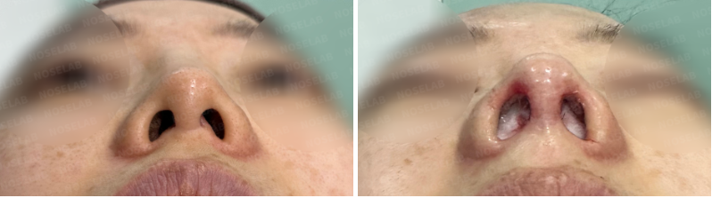 Before and after nostril photos showing reduced asymmetry and natural oval-shaped nostrils.