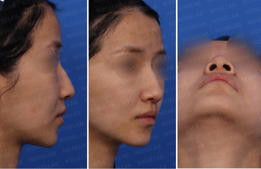 Preoperative consultation photos for closed rhinoplasty Korea: frontal view, left oblique side view, and left side view