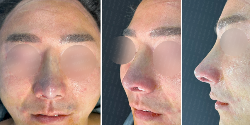 Immediately after surgery – frontal, side, and oblique side view photos showing correction of deviated nose and nasal asymmetry