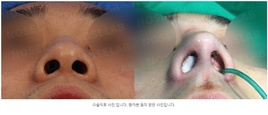 Nostril view after Closed Rhinoplasty Seoul – corrected hanging columella and nostril asymmetry with self rib cartilage graft at NoseLab.