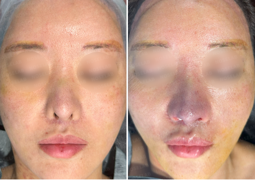 Corrective rhinoplasty after nostril reduction – before surgery (left) and immediate postoperative frontal view (right)