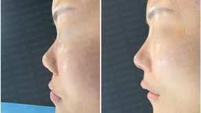 Before surgery (left) and immediately after autologous rib cartilage reconstruction (right) – side view comparison of female patient
