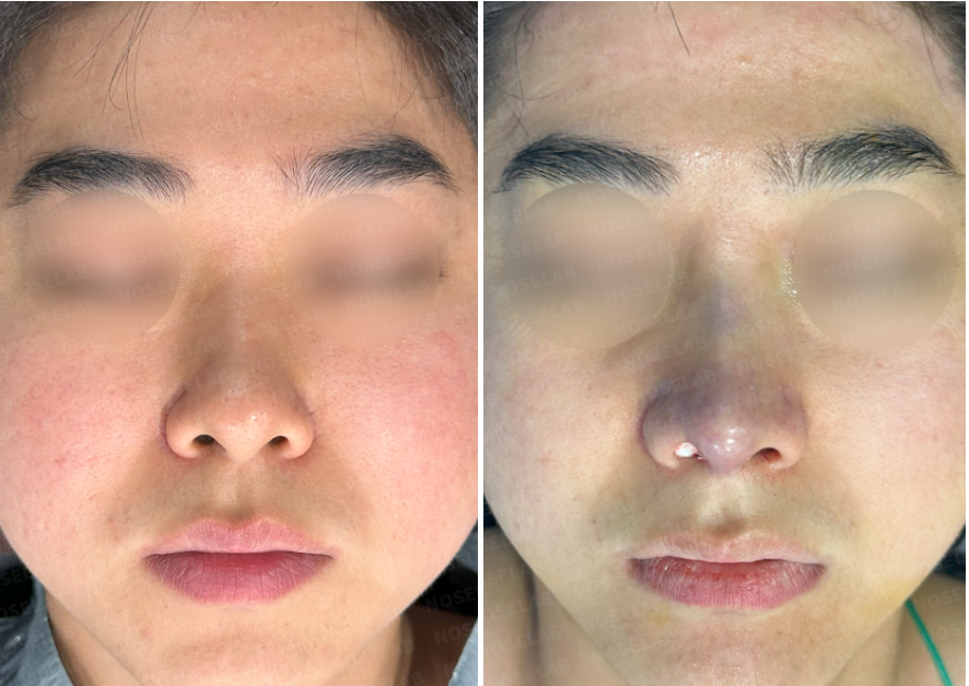 Before and immediately after Short and Low Nasal Bridge Rhinoplasty: frontal view showing refined nasal tip, improved bridge height, and enhanced facial balance.