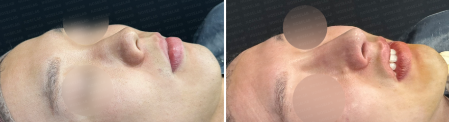 45-degree before-and-after photos of rhinoplasty for upturned nose, small nose, and nasolabial angle correction.