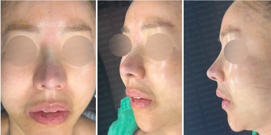 Immediately after secondary rhinoplasty: Frontal, 45-degree oblique, and side view photos showing improved nasal tip definition and feminine nasal contour.