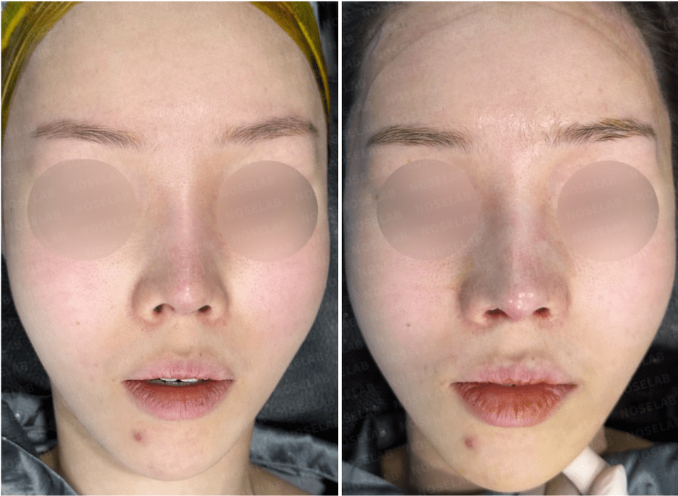 Photos were taken immediately before and after the surgery with the consent of the patient.