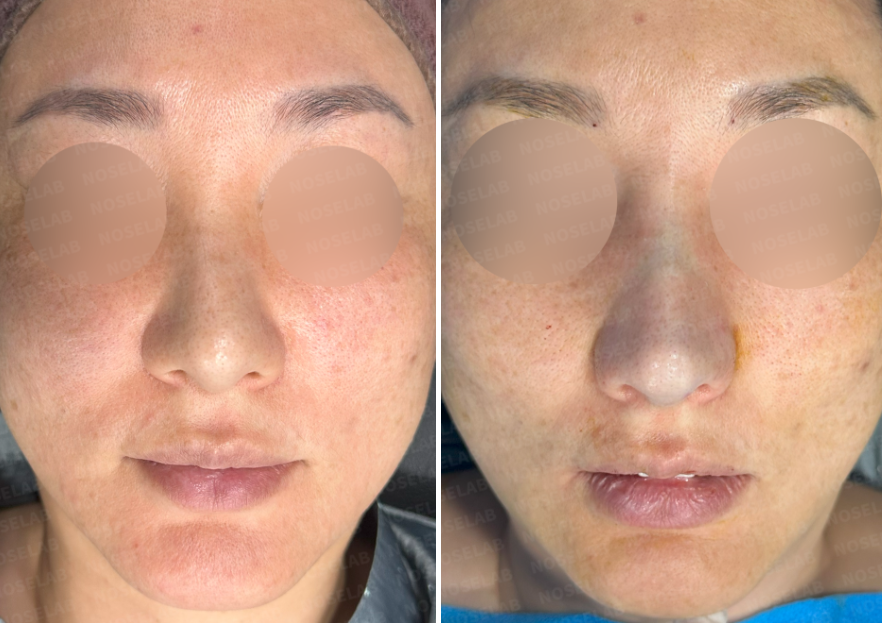 Frontal view photos before and immediately after revision rhinoplasty for crooked nose and hump correction using rib cartilage graft. Shows improved nasal alignment and tip projection.