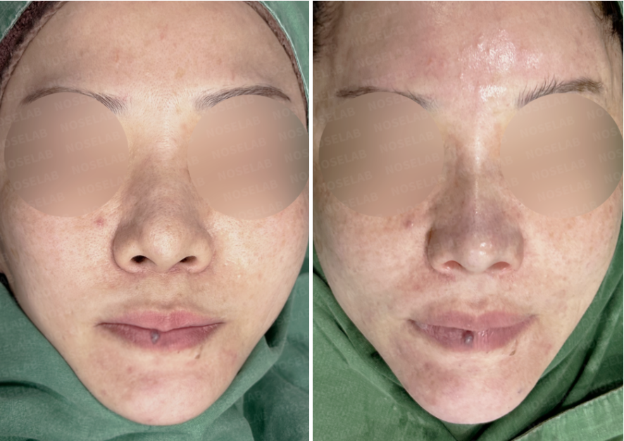 Before and after Calcified Rib Cartilage Rhinoplasty Korea, frontal comparison photos.