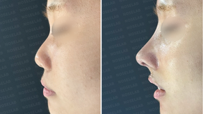 Before and after small blunt nose correction – side view comparison
