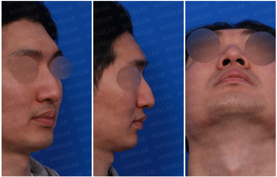 Preoperative views for autologous rib cartilage rhinoplasty: right profile, oblique angle, and nostril view showing dorsal hump, drooping tip, and nostril asymmetry.
