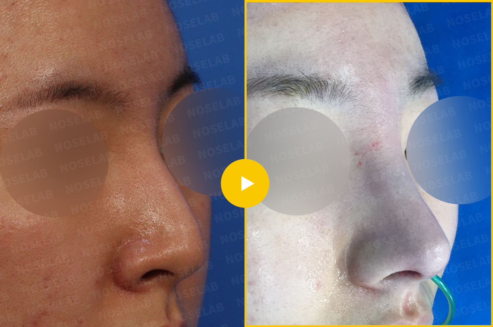 Three-quarter view comparison showing natural nasal profile improvement after comprehensive reshaping surgery