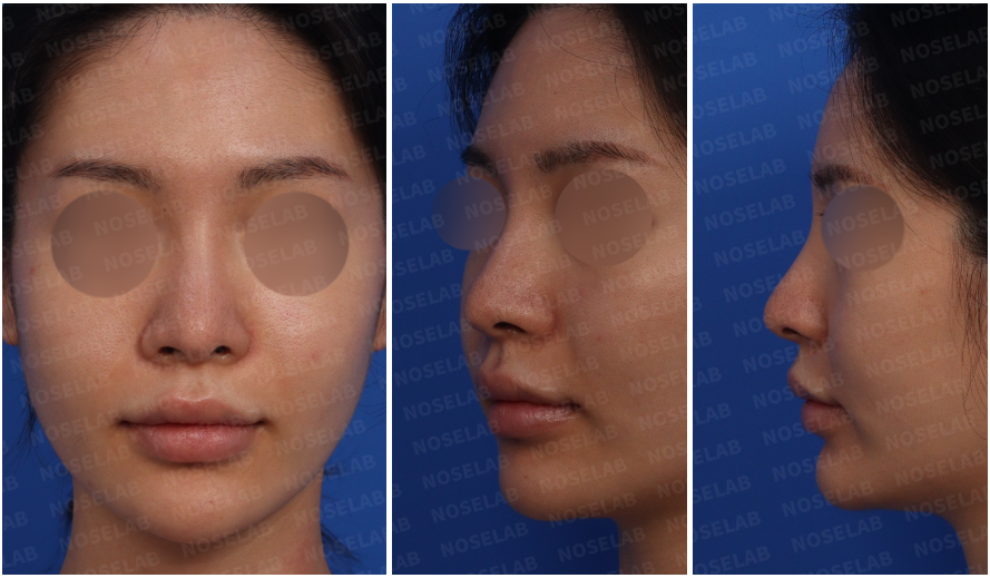 Pre-surgery design consultation photos showing the patient's frontal, left oblique, and side views before drooping nose correction."