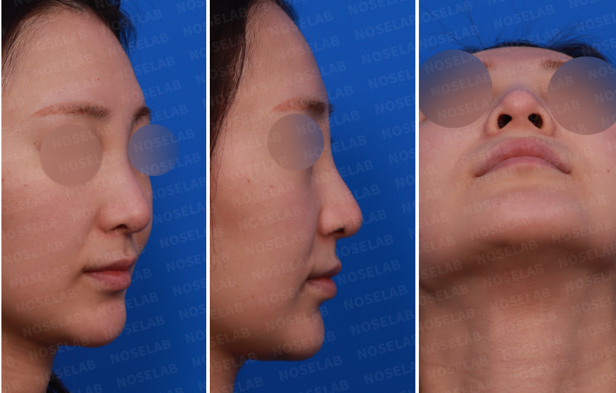 Design consultation photos showing right side, oblique side, and nostril views before nose filler removal and revision rhinoplasty.