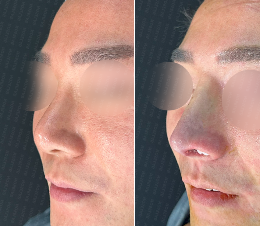 Oblique side view before and immediately after surgery – deviated nose correction and nasal tip reconstruction