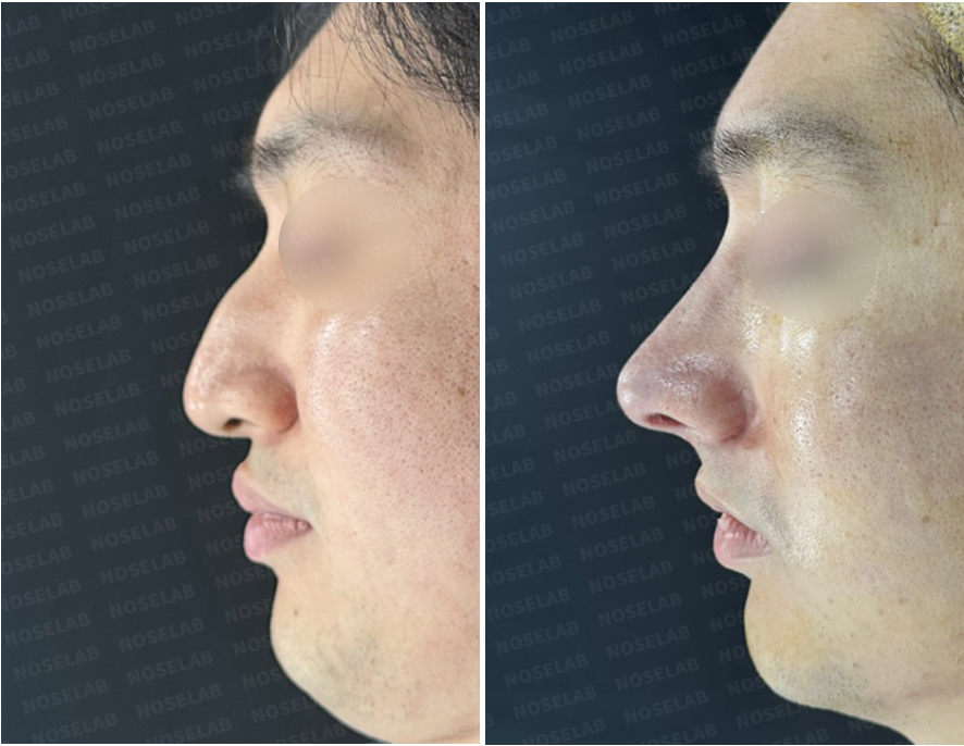 Side profile comparison before and after rib cartilage rhinoplasty – dorsal hump removal and improved nasolabial angle.