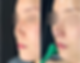 Oblique side view before and immediately after closed rhinoplasty Korea using rib cartilage — showing improved nasal tip projection and natural contour.