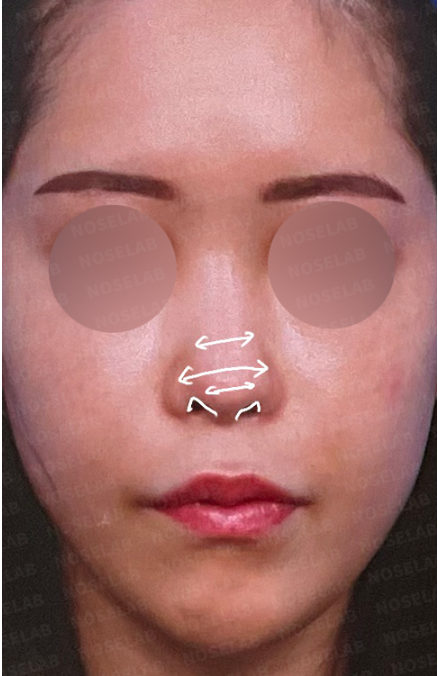 Frontal preoperative photo showing contracted nose with asymmetry and wide nasal base