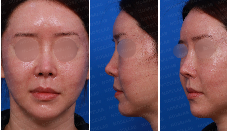 Pre-surgery design consultation photos showing frontal, right side, and oblique side views of the patient before revision rhinoplasty.