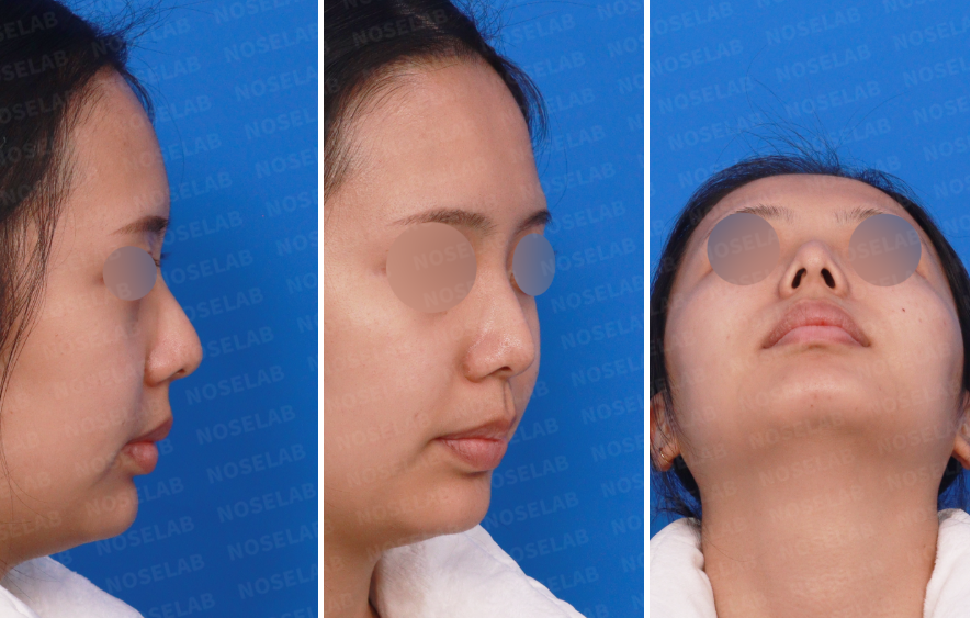 Crooked hump nose correction Korea with preoperative right side, oblique, and nostril views