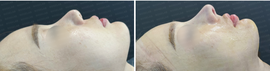 Side profile before surgery (left), After surgery (right)