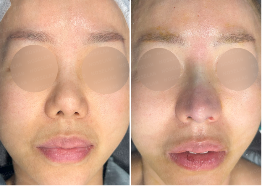 Frontal view comparison before and immediately after secondary rhinoplasty following silicone removal, showing improved nasal symmetry and refined tip.