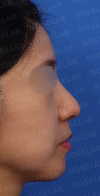 Preoperative lateral view showing droopy bulbous nose tip and low nasolabial angle before closed rhinoplasty in Korea