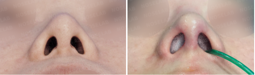 Revision rhinoplasty for short upturned nose – before and after nostril view photos