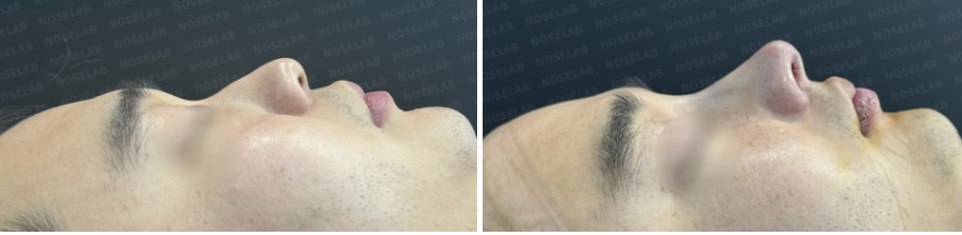 Before and after comparison – side view of a short and wide male nose before surgery (left) and immediate results after Male Rhinoplasty Korea with closed rhinoplasty (right), showing refined nasal tip and improved bridge height.