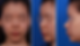 Pre-surgical photos showing a deviated nose and hidden columella: Frontal view, left side view, and oblique side view.