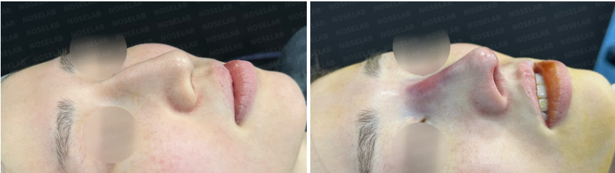 45-degree angle view before surgery (left) after surgery (right)