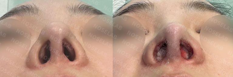Base view comparison illustrating improved nostril symmetry following nasal framework reconstruction surgery
